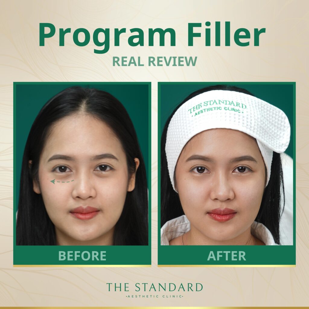ก่อนและหลังฉีด Filler