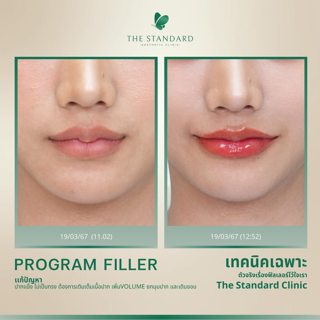 รีวิวฉีดฟิลเลอร์ปาก แก้ปัยหาปากบาง ไม่ได้รูป มุมปากตก